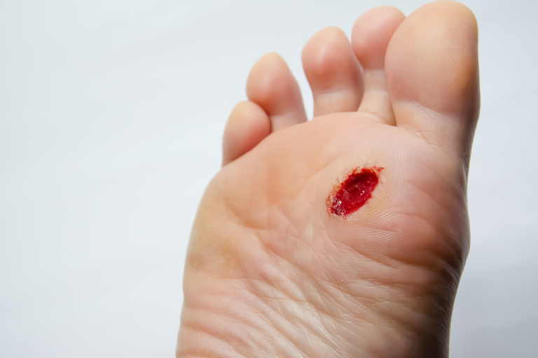  Cuidado de las heridas para la prevención del pie diabético