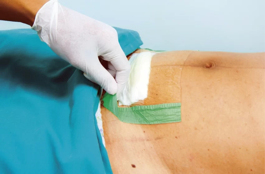  Cuidados de enfermería en pacientes sometidas a cesárea: enfoque integral y prevención de infecciones del sitio quirúrgico