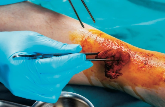  Heridas traumáticas sépticas: una amenaza silenciosa tras la lesión